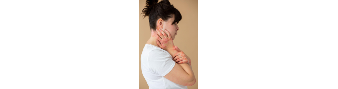 Homeopathic treatment: Psoriasis